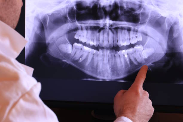 Best Emergency Wisdom Tooth Extraction in Lookout Mountain, TN